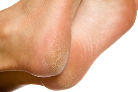A Rich, Thick Balm Applied Regularly Is Best for Very Dry Skin and Cracked Heels