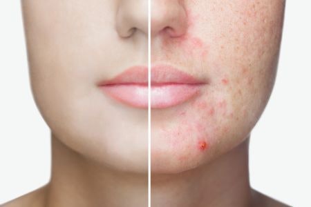 Colloidal Silver's Anti-Bacterial Properties Combat Acne Breakouts, Benzoin Will Heal and Soothe